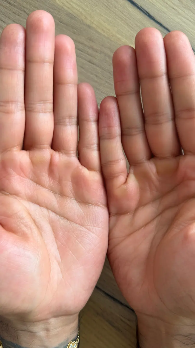 Palms after 10 uses